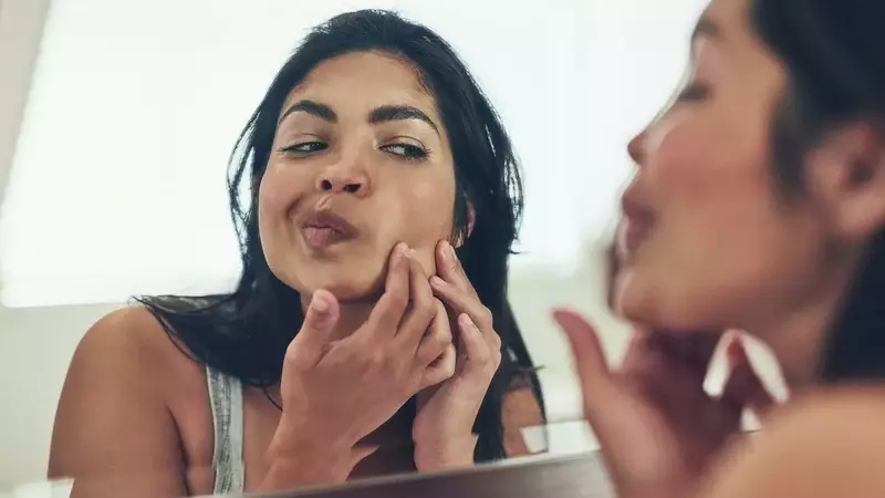 Understanding and Managing Postpartum Acne