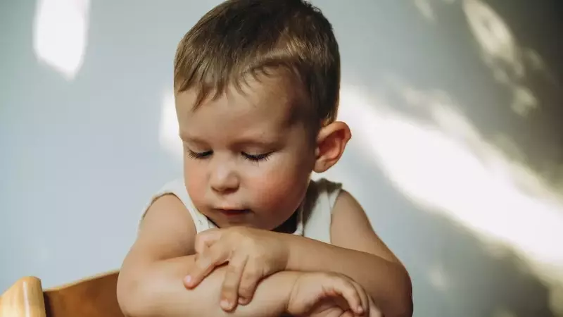Understanding and Managing Eczema in Children