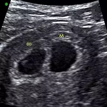 A Journey Through Twin Pregnancy: Ultrasound Milestones
