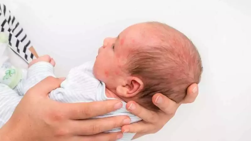 Test del bicchiere per eruzioni cutanee infantili: una guida vitale per i genitori